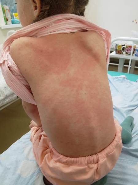 Больницы Шымкента переполнены, но чиновники отрицают, что дети массово болеют корью