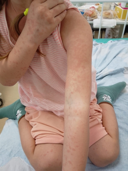 Больницы Шымкента переполнены, но чиновники отрицают, что дети массово болеют корью