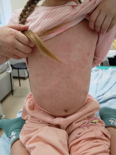 Больницы Шымкента переполнены, но чиновники отрицают, что дети массово болеют корью